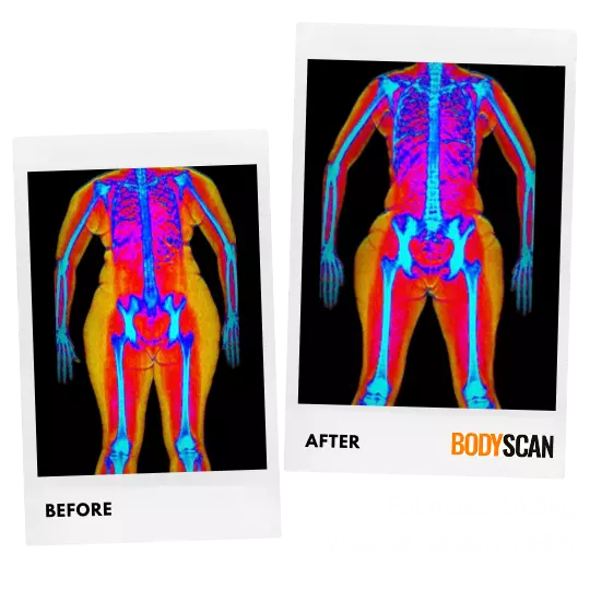 Idelkys's before and after weight loss dexa scan images