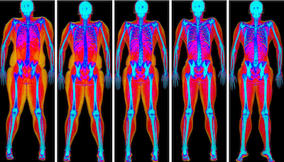 DEXA scan images for fat loss