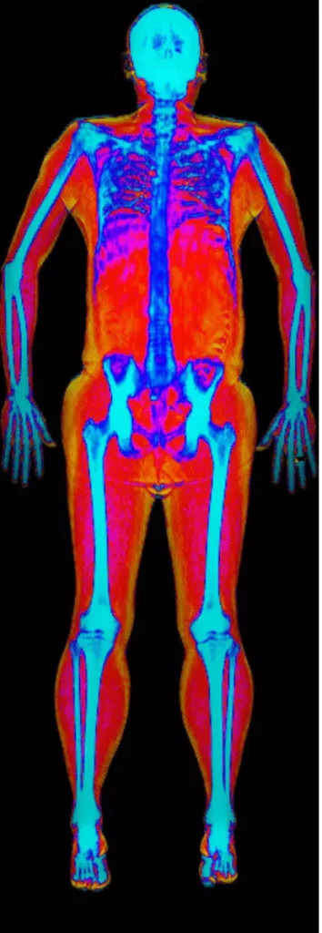 High visceral fat DEXA scan image, Peter Attia blog