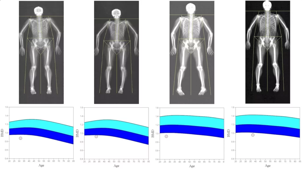 Low-bone-density-DEXA-scan-young-people